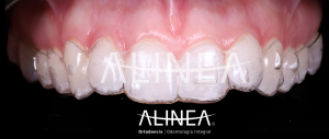 Invisalign