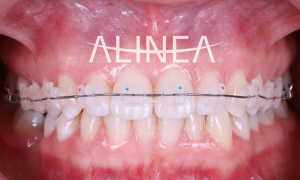 Alinea Ortodoncia Brackets Estéticos